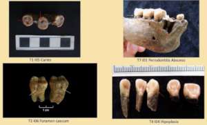 Examples of pathologies in teeth being studied