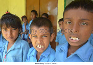 Children affected by fluoride in water