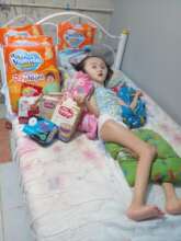 The little girl with hydrocephalus