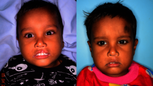 Eman Pre and Post
