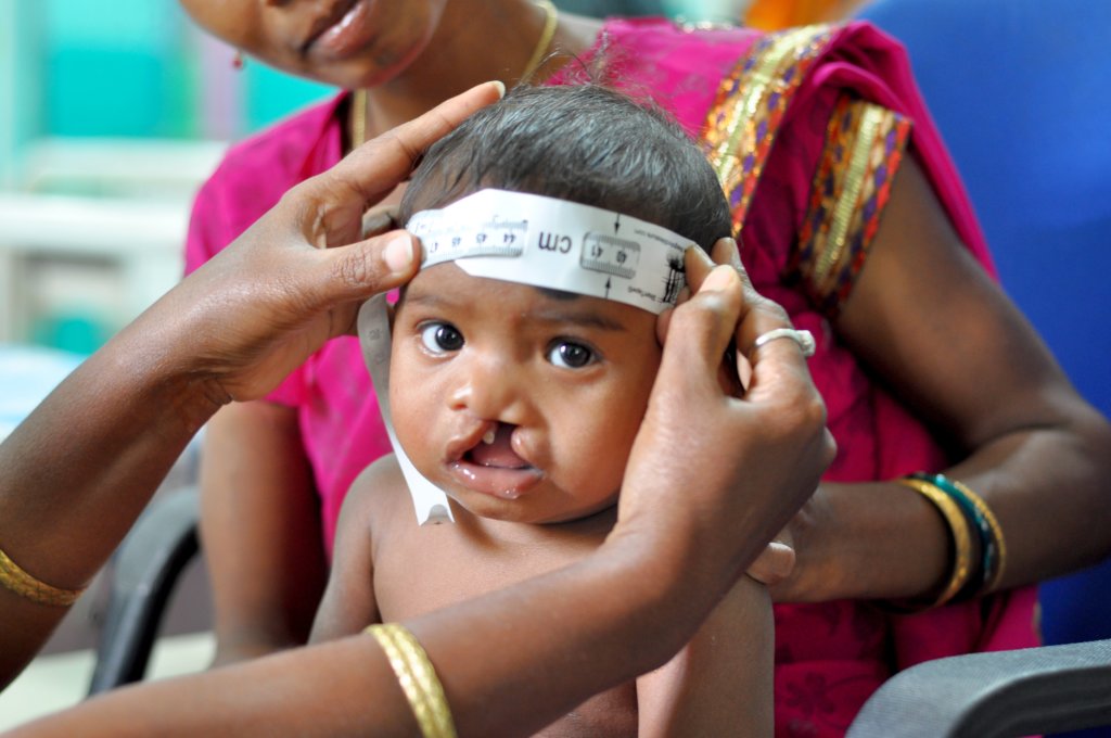 Nourish 1000 Malnourished Children 4 Cleft Surgery