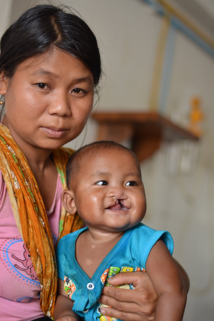 Nourish 1000 Malnourished Children 4 Cleft Surgery