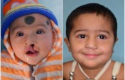 Nourish 1000 Malnourished Children 4 Cleft Surgery