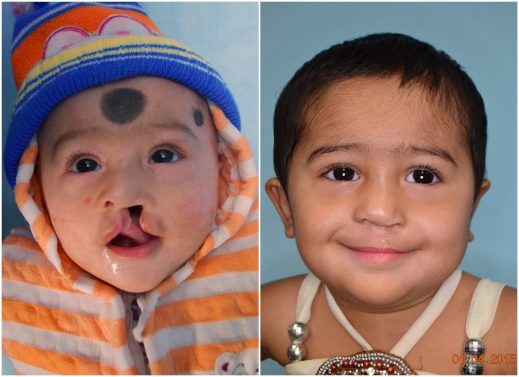 Nourish 1000 Malnourished Children 4 Cleft Surgery