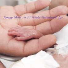 23 weeks gestational age 1 lbs. 1 oz.