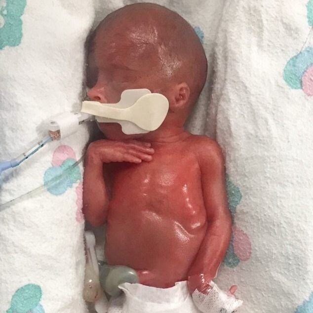 Reports on Saving Viable 24-Week Preemies GlobalGiving