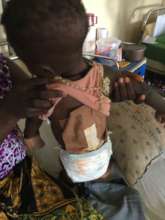 Chimamanda after surgery from the back