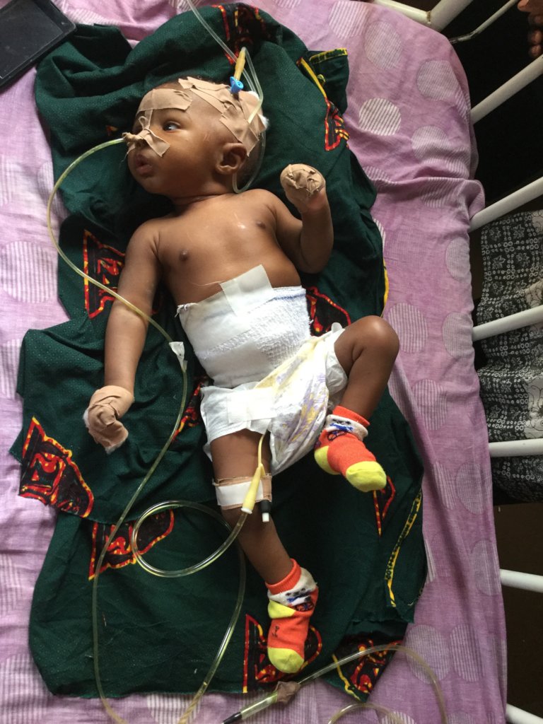 Life-saving surgery for 24 children in S.E Nigeria
