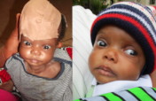Life-saving surgery for 24 children in S.E Nigeria