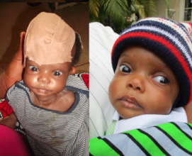 Life-saving surgery for 24 children in S.E Nigeria