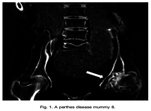 Support Children with Rare Hip Disease