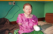 Safe Water to 120 Albino Families in Tanzania
