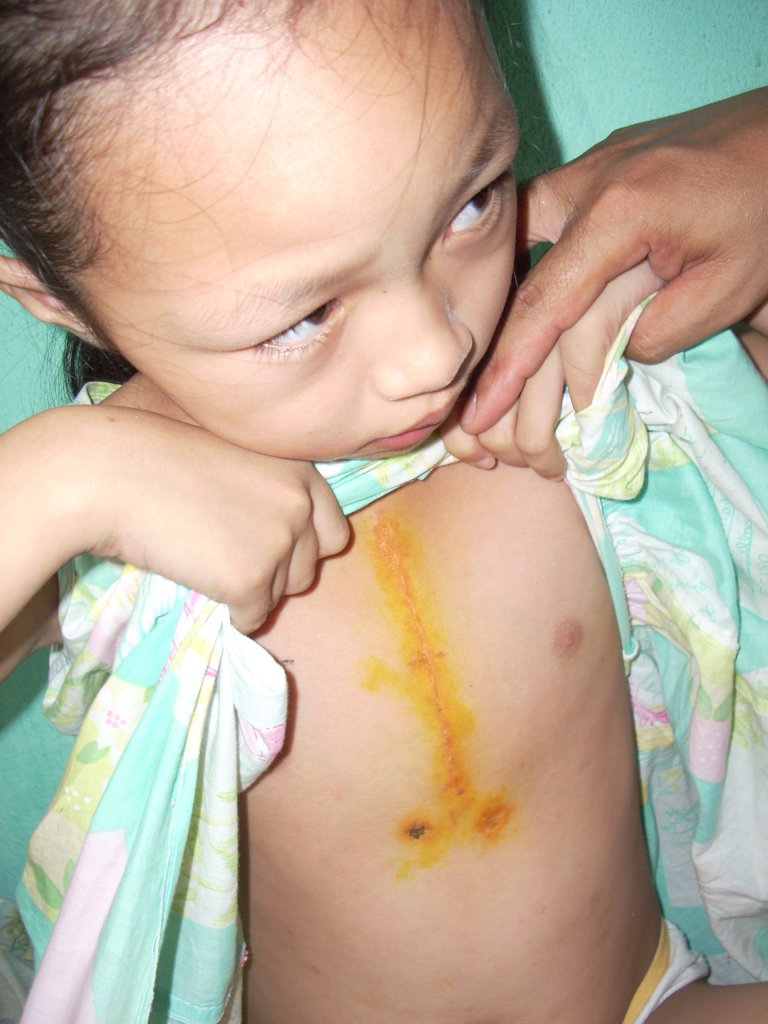 Children's Heart Surgery Program