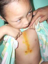 Children's Heart Surgery Program