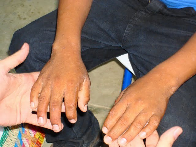 Life-changing surgery for the poor of Guatemala