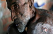 Provide Rescue Vans to 100 DyingDestitute in India