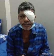 47 yr old operated for RD