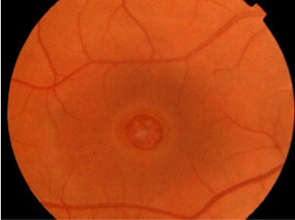 fundus photo of macula hole