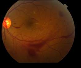 Fundus photo of PDR with Vitreous Heamorrhage