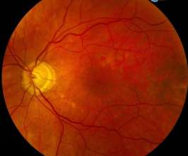 fundus photo of macula hole