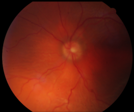 fundus photo of macula off retinal detachment