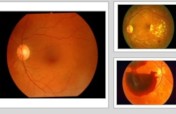 Complex Retinal Surgeries in Diabetic Retinopathy