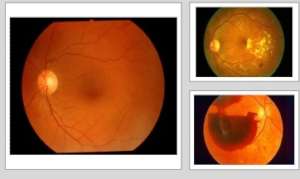 Complex Retinal Surgeries in Diabetic Retinopathy