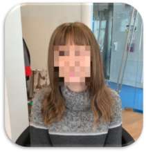 Wig for alopecia patient