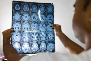Emergency brain surgery after a tumor is found.