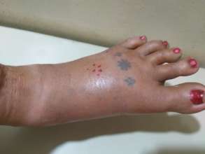 06jul2019_Neera_swelling at bite site