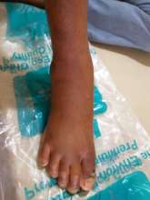 Harish will be seen in followup for the edema