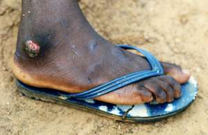 Infection of Guinea Worm