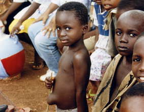 A boy with an umbilical hernia