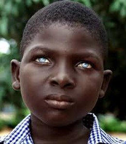 Save a Childs Sight and Change a Life In Rombo