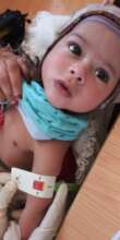 While measuring a malnourished child