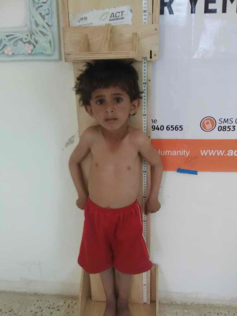 Malnutrition children U5yr &  PLW in Yemen