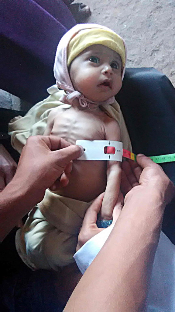 Malnutrition children U5yr &  PLW in Yemen