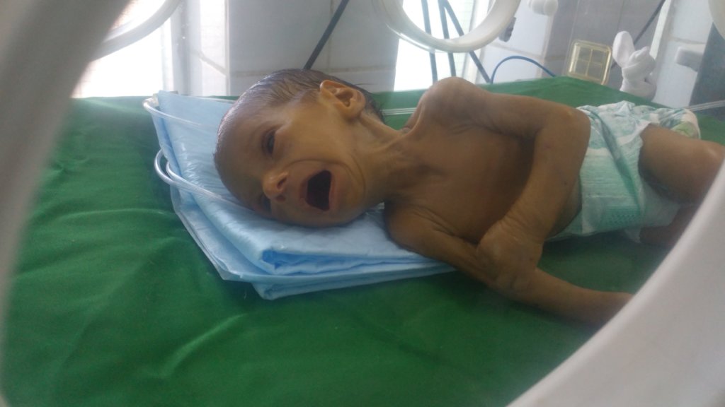 Malnutrition children U5yr &  PLW in Yemen