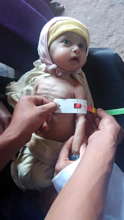 Ahmed .. One of the victims of malnutrition