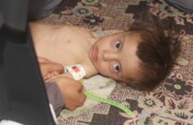 Malnutrition children U5yr &  PLW in Yemen