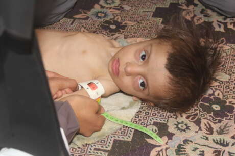 Malnutrition children U5yr &  PLW in Yemen