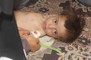 Malnutrition children U5yr &  PLW in Yemen