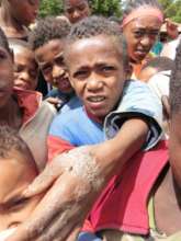 Example of skin disease due to contaminated water