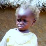 A child with bleached hair due to malnutrition