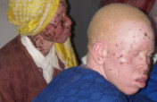 Rescue 120 Persons with Albinism in Malawi