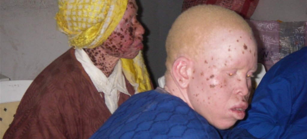 Rescue 120 Persons with Albinism in Malawi