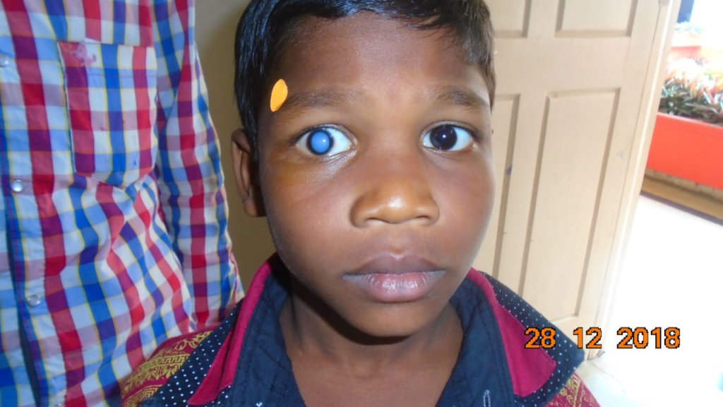 TRIEYE-  Tribal  children eye care