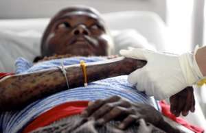 HIV-AIDS is is a world enemy to humanity