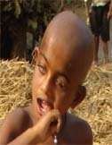 Vision impaired Children With Disability -CWDs