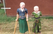 Save 150 Albino Person from Skin Cancer inTanzania